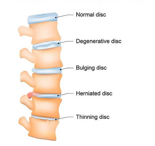 What are the stages of degenerative disc disease