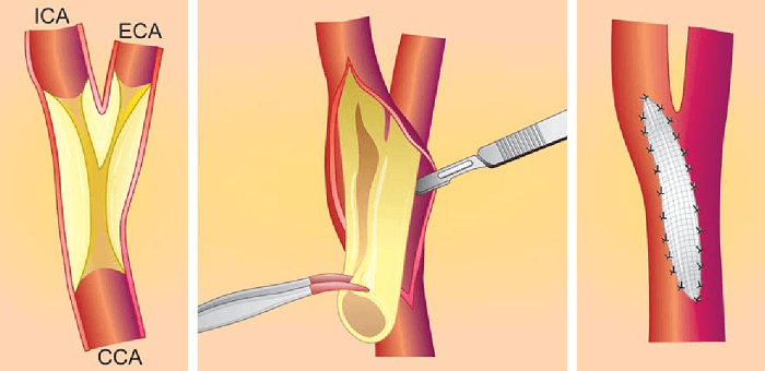 Carotid Surgery or Stenting